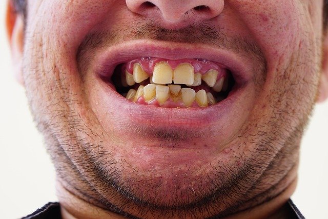 crooked teeth 5826595 640