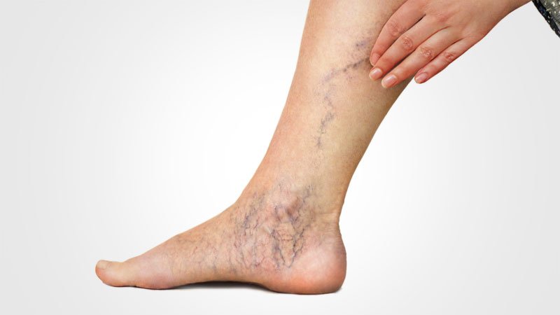 Varicose Veins