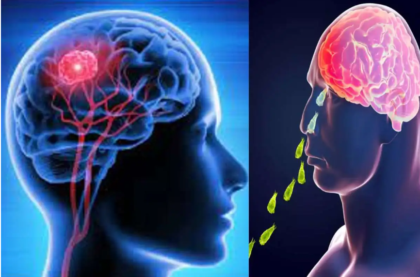 केरल में दिमाग खाने वाले अमीबा से दहशत ! एक महीने में 6 मौतें, मलप्पुरम के 47 वर्षीय शख्स की भी जान गई 1 image 56